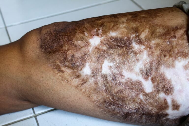 Photograph of a man who sustained a burn wound on his leg.