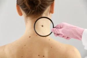 Dermatologist examining moles of patient on light background. 