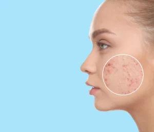 Close-up of a woman's face with acne under a magnifying glass 