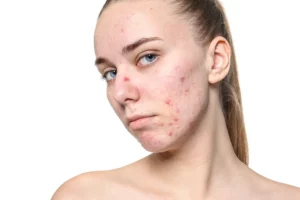 A photograph of a young woman with severe acne pustules