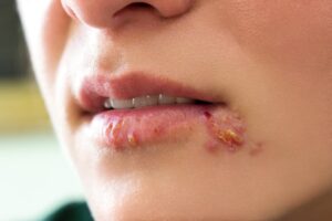 Girl lips showing herpes blisters.