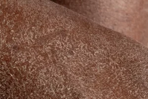 Macro detail of the dry skin of the legs of an African woman. Selective focus of dehydrated peeling skin. 