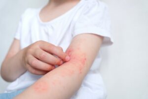 The child scratches atopic skin. Dermatitis, diathesis, allergy on the child's body, eczema.