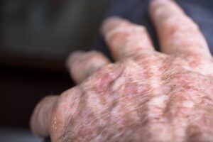 Photograph of an elderly man's hand with actinic keratosis lesions visible