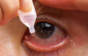 Dripping a red eye with eye drops close up.