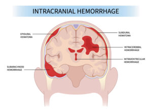 Vector illustrating an intracranial haemorrhage