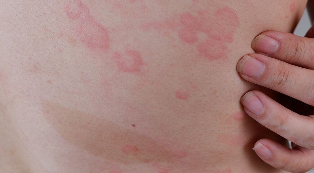 AR_urticaria