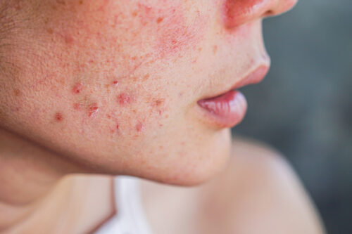 A dermatologist examining a patient's skin for acne treatment