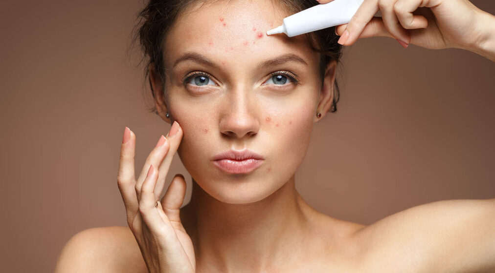 Teen girl with problem skin applying treatment cream on beige background. Skin care concept