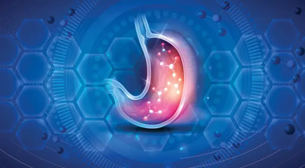 A graphic representation of gastro-oesophageal reflux disease (GORD).