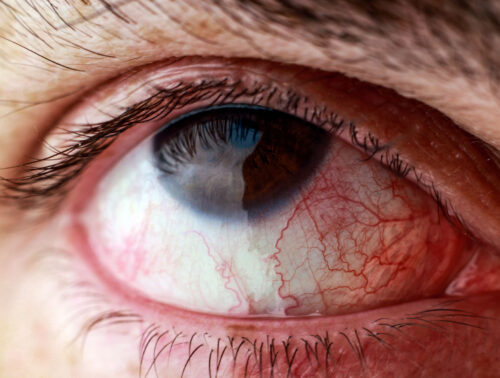 Image showing symptoms of allergic conjunctivitis