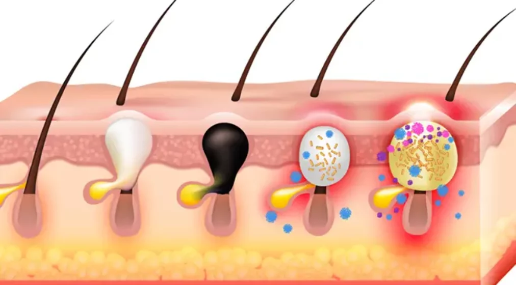 Dermatology expert, Dr. Willie Visser presenting at a CPD-accredited webinar on Acne vulgaris treatment and latest trends in Isotretinoin use.