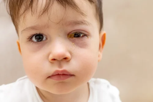 Boy with crust in his right eye