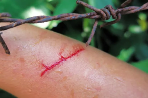 Red bleeding cut accident wound on arm with old sharp spike rusty wire steel abrasion or scrape skin, that high risk to tetanus bacterial infection.