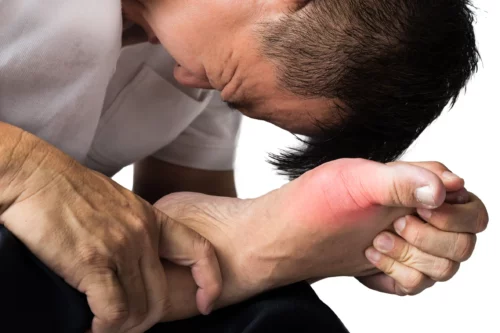 Man with painful and inflamed gout on his foot around the big toe area.