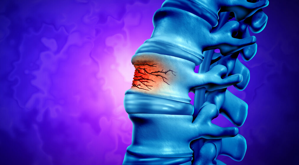 Traumatic Spine Fracture and vertebral injury medical concept as a human anatomy spinal column with a broken burst vertebra due to compression or other osteoporosis back disease as a 3D illustration.