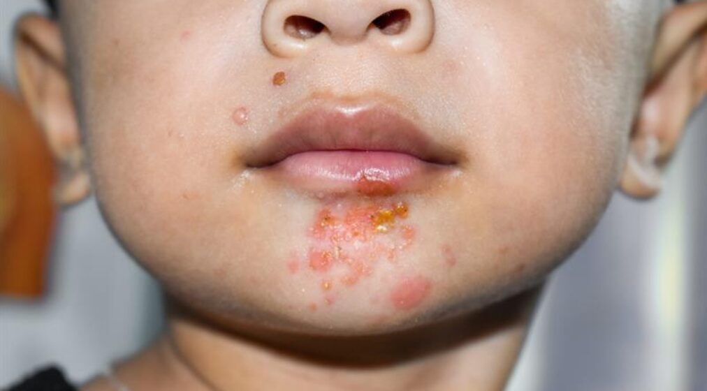 Staphylococcal skin infection called impetigo around mouth of Asian child.