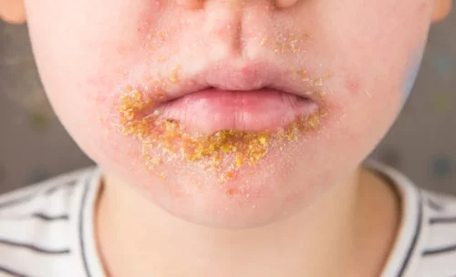 5 year old child with Impetigo (nonbullous impetigo) which is a bacterial infection that involves the superficial skin. Yellow scabs on infected area.