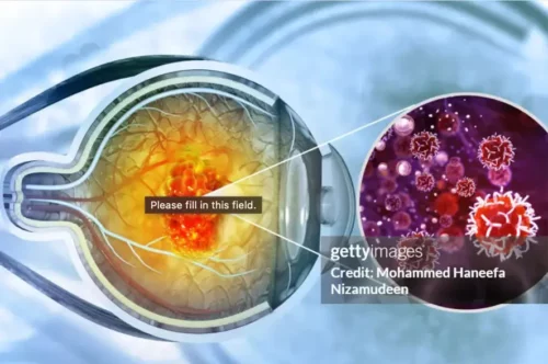 Loteprednol etabonate and tobramycin eye drops 