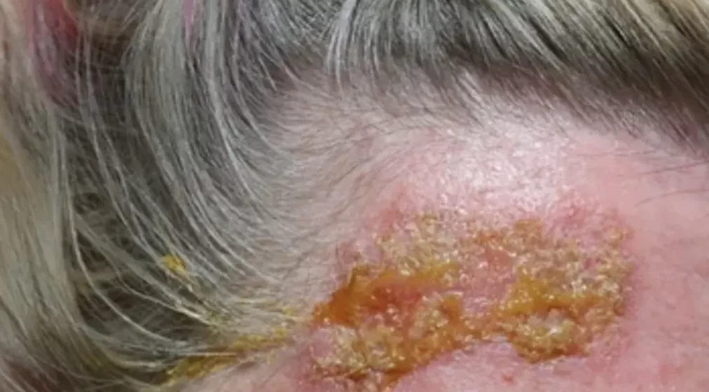 Actinic keratosis webinar