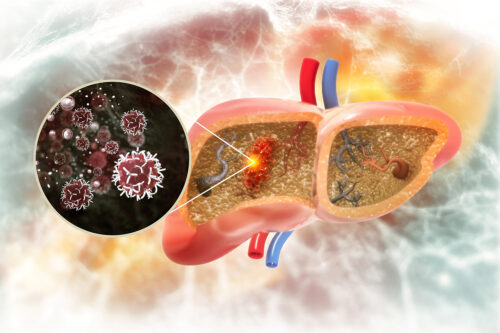 Vector of a liver with a focus on the tumour cells growing within the liver