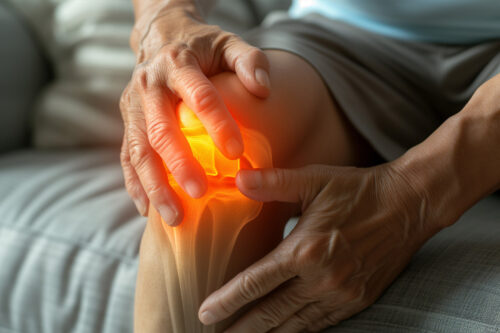 An illustration of osteoarthritis affecting the knee joint