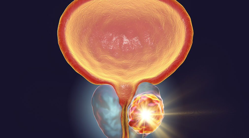 Conceptual image for prostate cancer treatment, 3D illustration showing destruction of a tumor inside prostate gland