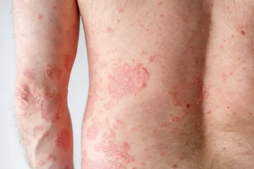 Papules of chronic psoriasis vulgaris on male arm and back body on neutral background. Genetic immune disease.