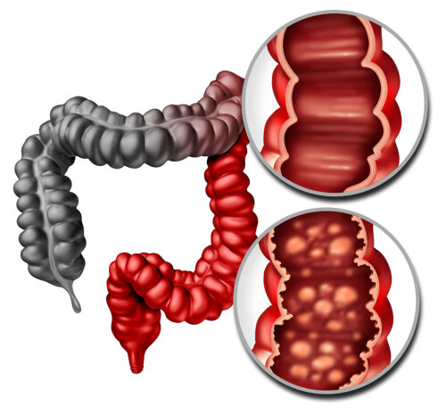 Ulcerative colitis as an inflammatory intestine with healthy and ulcerated inner bowel lining disease with a human rectum and colon as a digestive system and digestion concept as a 3D illustration.