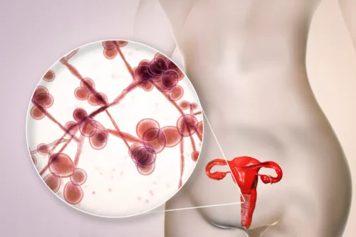 vaginal candidiasis