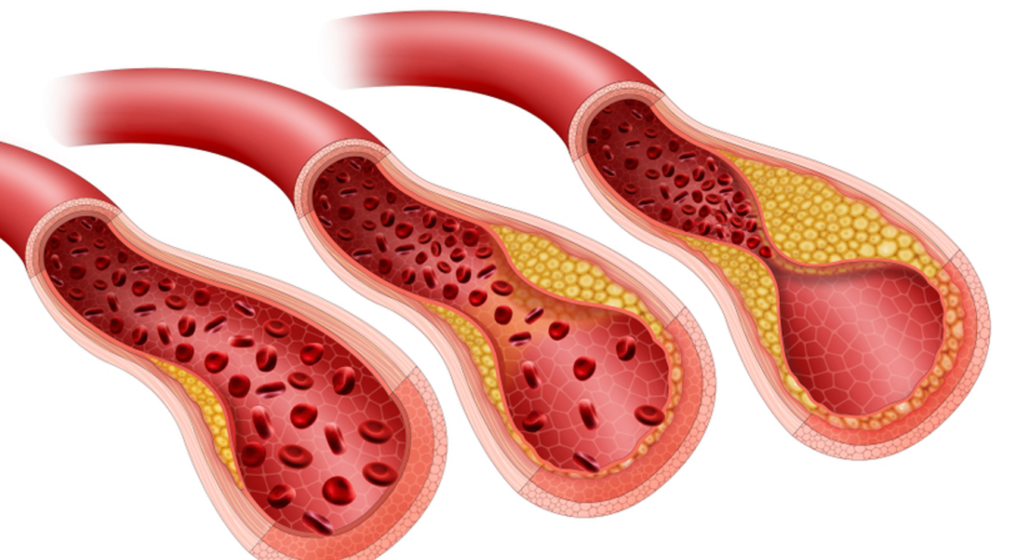 cholesterol veins