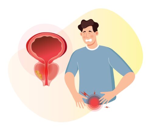 Person,With,Inflamed,Prostate,Gland,Having,Difficulty,-,Stock,Illustration