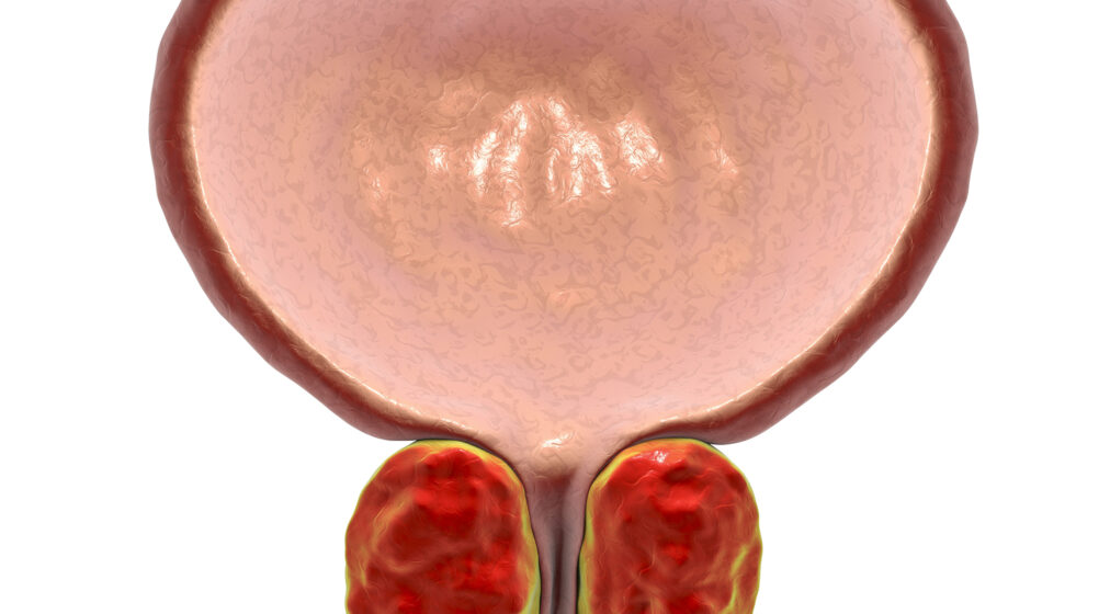 Benign prostatic hyperplasia, 3D illustration showing enlarged prostate gland